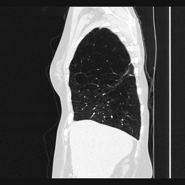 File:Centrilobular pulmonary emphysema (Radiopaedia 24495-24789 Sagittal lung window 15).jpg