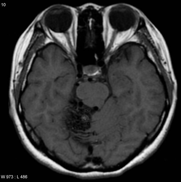 File:Cerebellar arteriovenous malformation (Radiopaedia 5220-6988 Axial T1 1).jpg