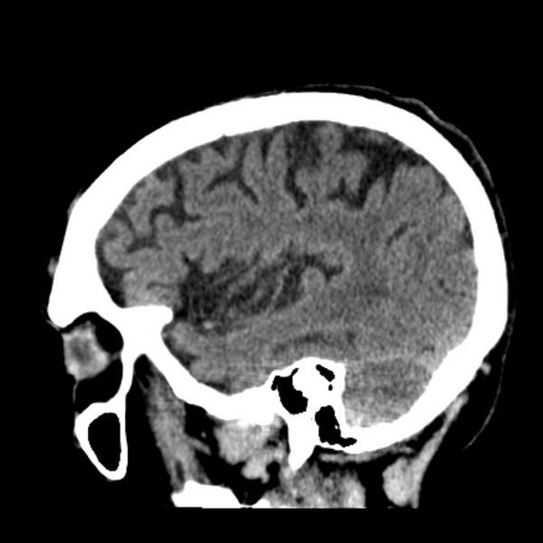 File:Cerebellar hemorrhage (Radiopaedia 27193-27359 C 35).jpg