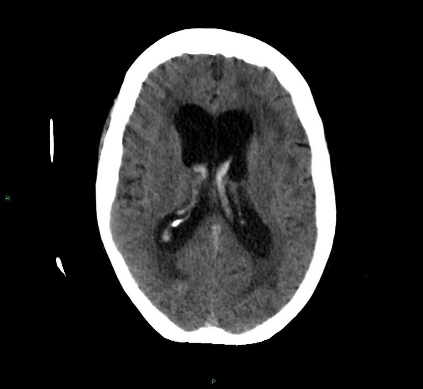Cerebellar hemorrhage (Radiopaedia 58792-66026 Axial non-contrast 23).jpg