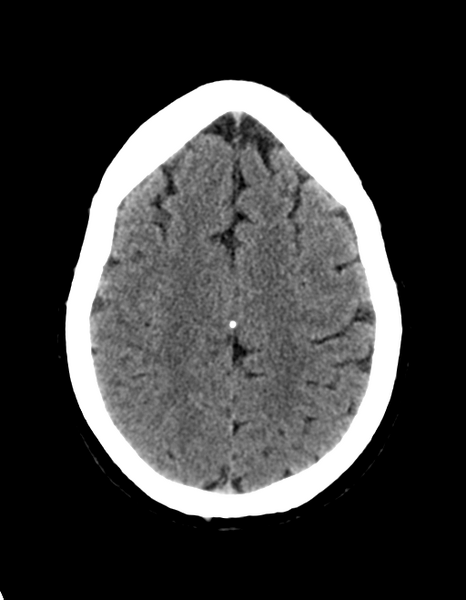 File:Cerebellar infarct due to vertebral artery dissection with posterior fossa decompression (Radiopaedia 82779-97030 Axial non-contrast 26).png