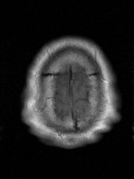 File:Cerebellopontine angle meningioma (Radiopaedia 24459-24764 Axial T1 23).jpg