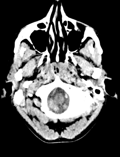 File:Cerebral abscess (Radiopaedia 60342-68008 Axial non-contrast 6).png
