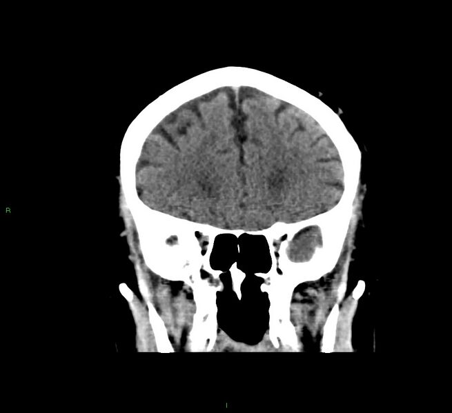 File:Cerebral amyloid angiopathy-associated lobar intracerebral hemorrhage (Radiopaedia 58376-65511 Coronal non-contrast 47).jpg