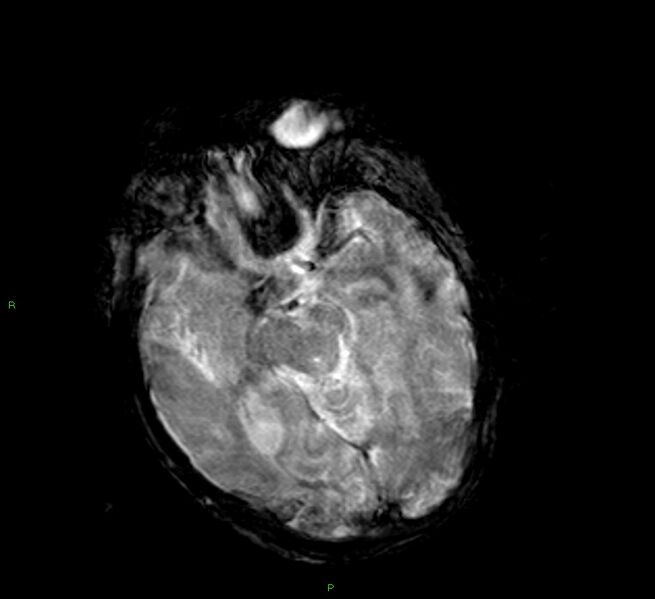 File:Cerebral amyloid angiopathy-associated lobar intracerebral hemorrhage (Radiopaedia 58377-65515 Axial Gradient Echo 16).jpg