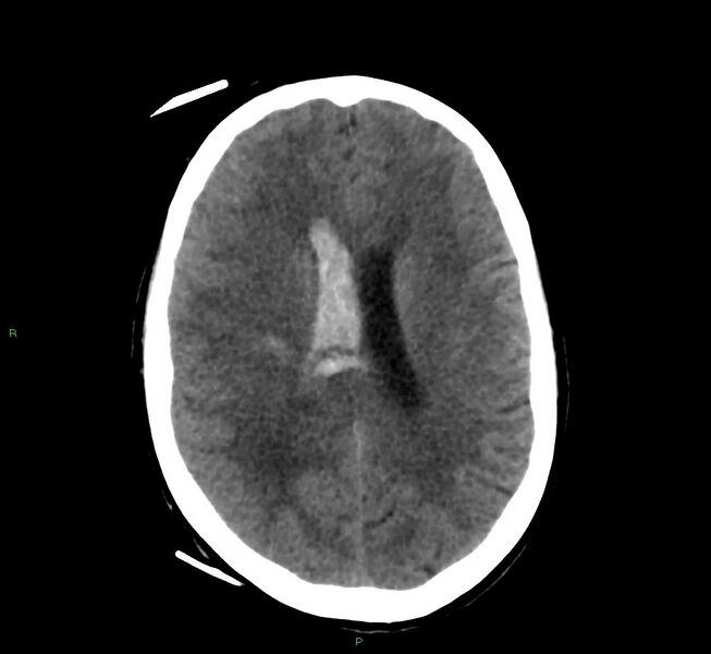 File:Cerebral amyloid angiopathy-associated lobar intracerebral hemorrhage (Radiopaedia 58566-65730 Axial non-contrast 22).jpg