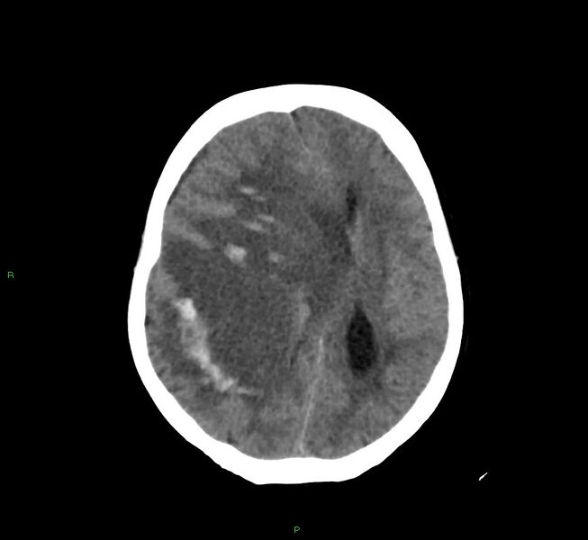 File:Cerebral amyloid angiopathy-associated lobar intracerebral hemorrhage (Radiopaedia 58751-65972 Axial non-contrast 22).jpg