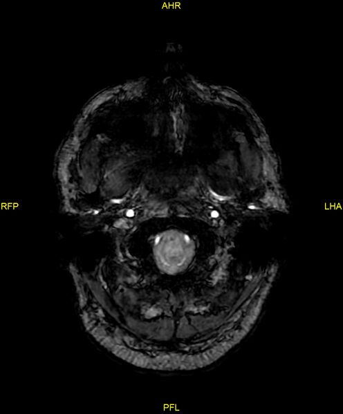 File:Cerebral autosomal dominant arteriopathy with subcortical infarcts and leukoencephalopathy (CADASIL) (Radiopaedia 86108-102054 Axial SWI 10).jpg