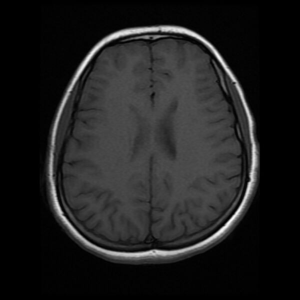 File:Cerebral cavernous malformation (Radiopaedia 44301-47942 Axial T1 14).jpg