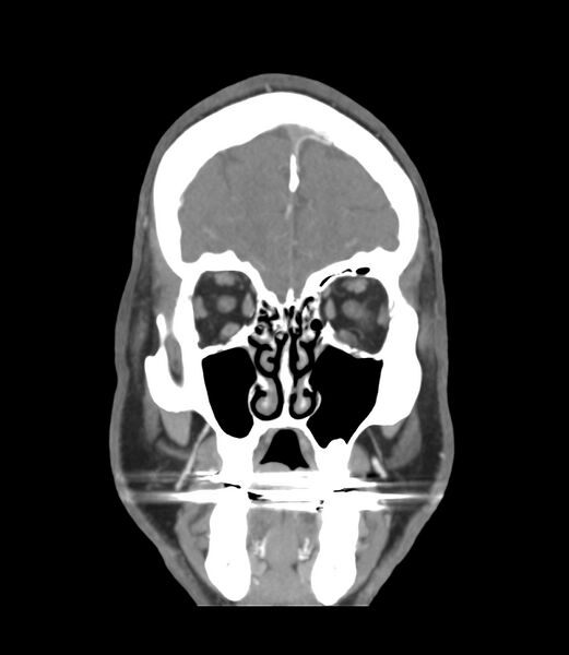 File:Cerebral dural venous sinus thrombosis (Radiopaedia 86514-102576 B 6).jpg