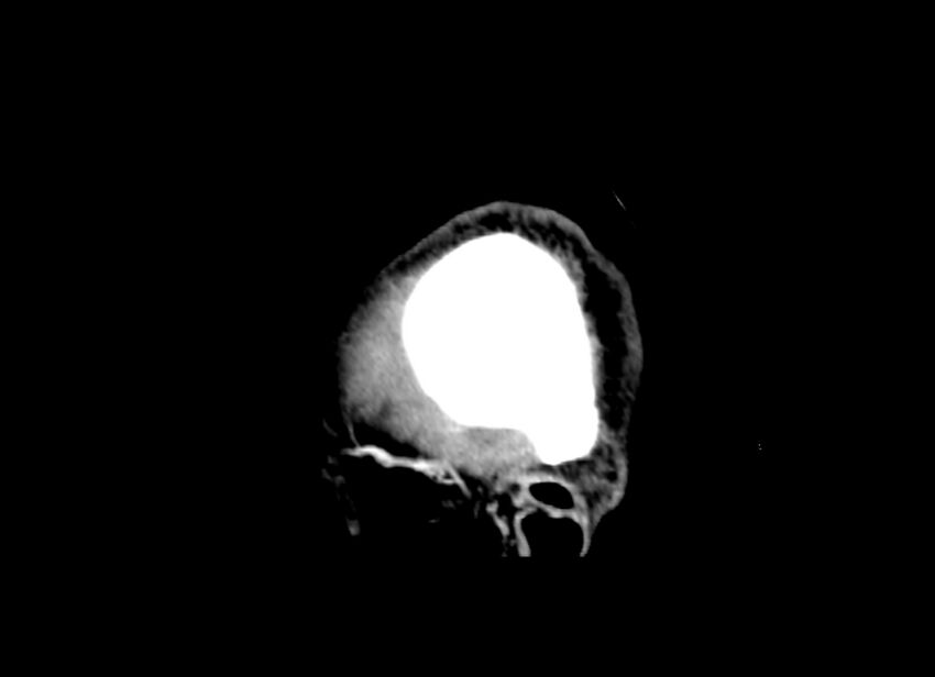 Cerebral edema (Radiopaedia 82519-96661 D 5).jpg