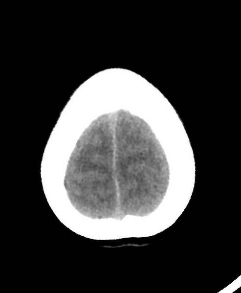 File:Cerebral edema due to severe hyponatremia (Radiopaedia 89826-106937 Axial non-contrast 84).jpg