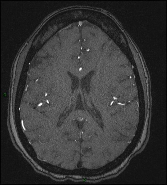 File:Cerebral fat embolism (Radiopaedia 35022-36525 Axial TOF 126).jpg
