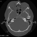 Cerebral hemorrhagic contusion with subdural and subarachnoid hemorrhage (Radiopaedia 10680-11146 Axial bone window 10).jpg
