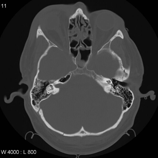 File:Cerebral hemorrhagic contusion with subdural and subarachnoid hemorrhage (Radiopaedia 10680-11146 Axial bone window 10).jpg