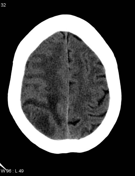 File:Cerebral metastasis - lung cancer (Radiopaedia 5315-7072 Axial non-contrast 11).jpg