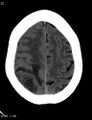 Cerebral metastasis - lung cancer (Radiopaedia 5315-7072 Axial non-contrast 11).jpg