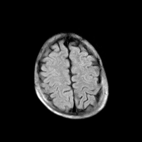 File:Cerebral tuberculoma (Radiopaedia 41152-43932 Axial FLAIR 19).jpg
