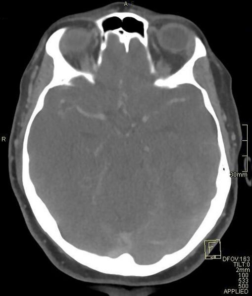 File:Cerebral venous sinus thrombosis (Radiopaedia 91329-108965 Axial venogram 33).jpg
