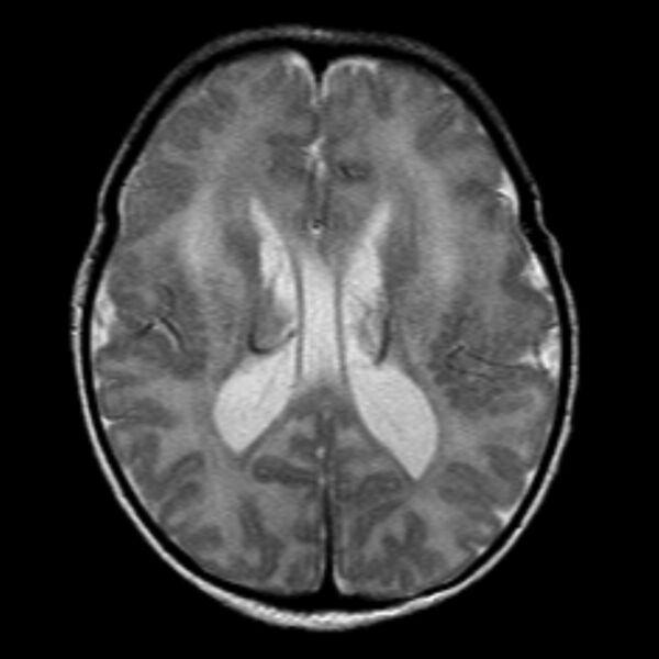 File:Cerebrohepatorenal syndrome (Zellweger syndrome) (Radiopaedia 8346-9187 Axial T2 1).jpg