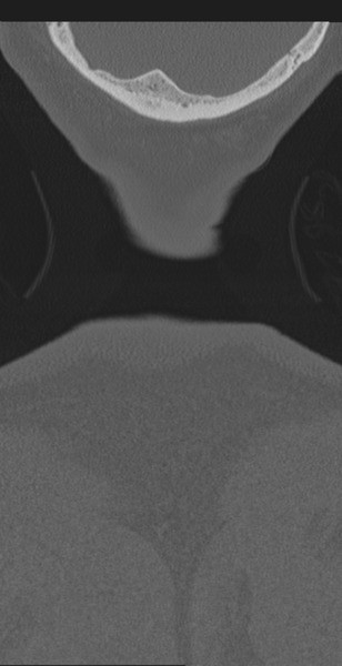 File:Cervical canal stenosis due to ossification of the posterior longitudinal ligament (Radiopaedia 47260-51823 Coronal bone window 82).png