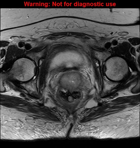File:Cervical cancer (Radiopaedia 24151-24410 Axial T2 22).jpg