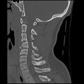 Cervical flexion teardrop fracture with cord hemorrhage (Radiopaedia 32497-33454 Sagittal bone window 26).jpg