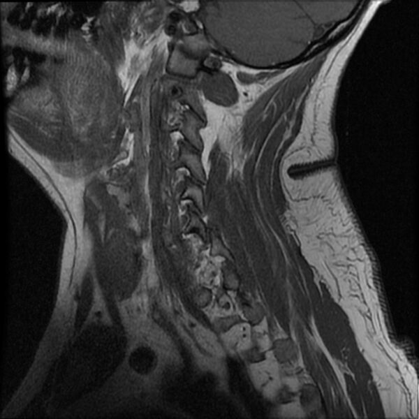 File:Cervical fracture and dislocation with locked facet (Radiopaedia 31837-32781 Sagittal T1 1).jpg
