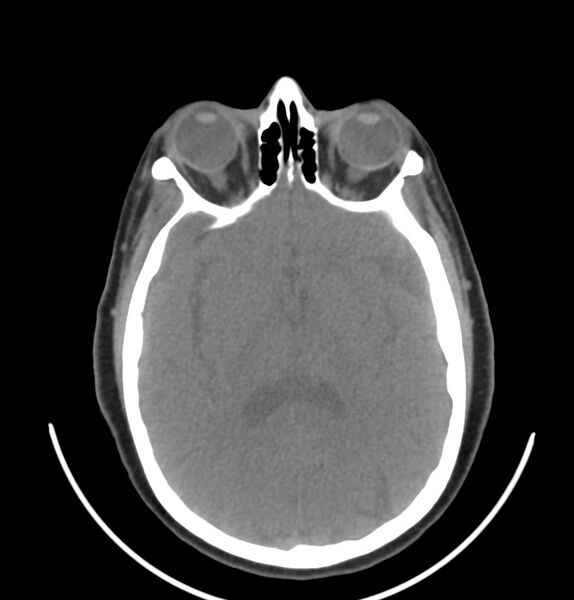 File:Cervical lymphadenopathy- cause unknown (Radiopaedia 22420-22457 non-contrast 47).jpg