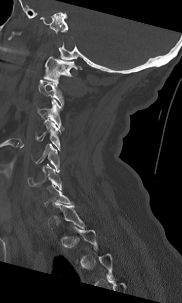 File:Cervical spine fracture - chalk stick (Radiopaedia 39116-41323 Sagittal bone window 20).png