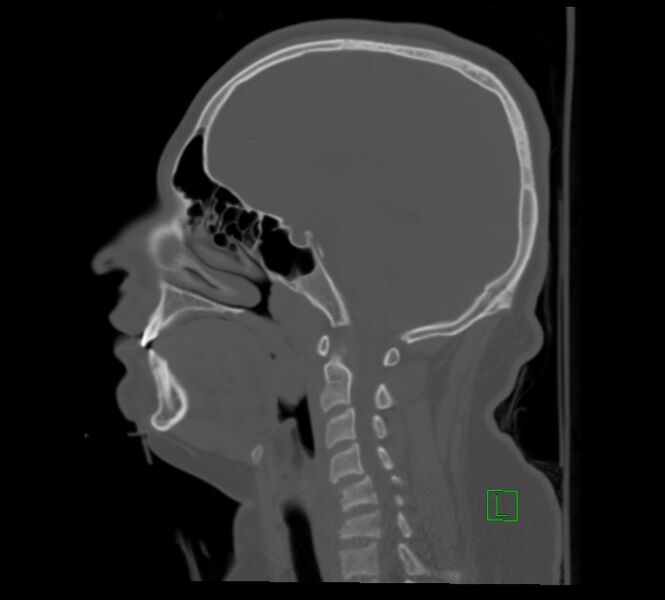 File:Cervical spine fracture - hyperflexion injury (Radiopaedia 66184-75364 A 16).jpg