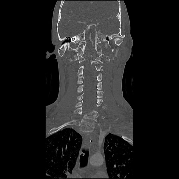 File:Cervical spine fractures with vertebral artery dissection (Radiopaedia 32135-33078 Coronal bone window 13).jpg