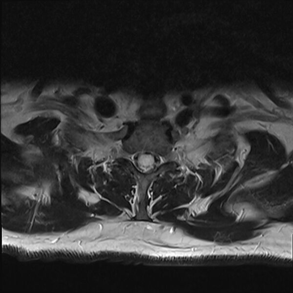 File:Cervical tumor-like myelopathy due to Type V dAVF (Radiopaedia 82461-96604 Axial T2 33).jpg