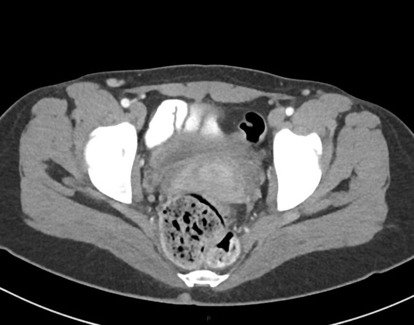 Cesarean scar endometriosis (Radiopaedia 82925-97262 A 79).jpg