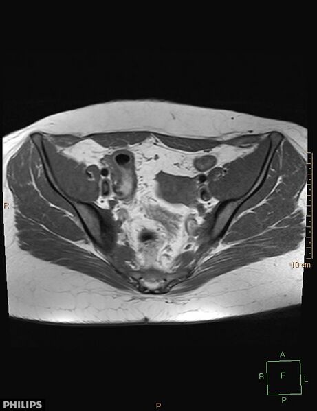 File:Cesarian scar endometriosis (Radiopaedia 68495-78066 Axial T1 8).jpg