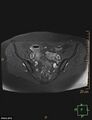 Cesarian scar endometriosis (Radiopaedia 68495-78066 Axial T1 C+ fat sat 8).jpg