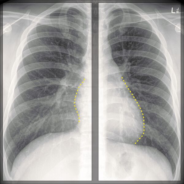 File:Chest x-ray - breathing (Radiopaedia 32556-33507 H 1).jpg
