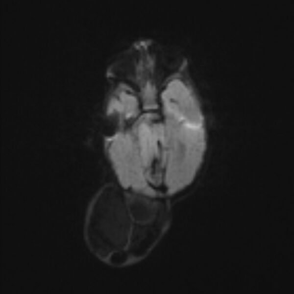 File:Chiari III malformation with occipital encephalocele (Radiopaedia 79446-92559 Axial DWI 30).jpg