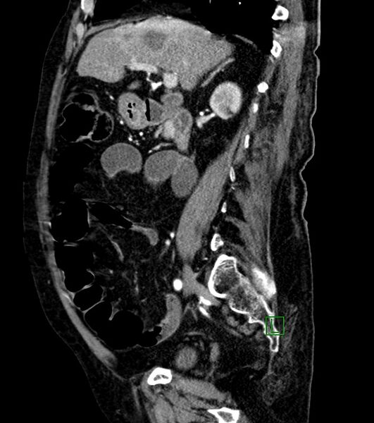 File:Cholangiocarcinoma with cerebral metastases (Radiopaedia 83519-98629 F 75).jpg