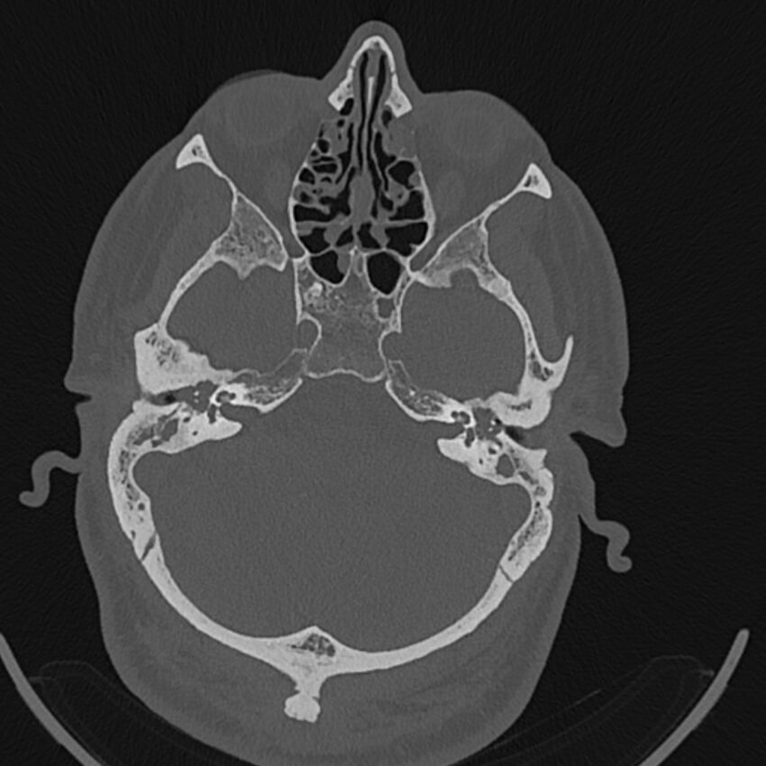 Cholesteatoma (Radiopaedia 68176-77673 Axial bone window 43).jpg