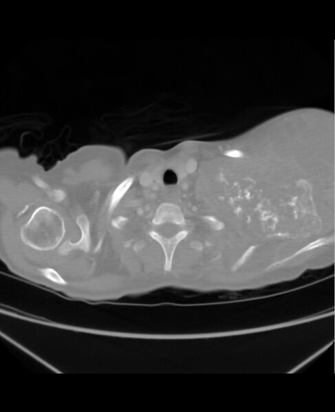 File:Chondrosarcoma (Radiopaedia 79427-92535 Axial lung window 3).jpg