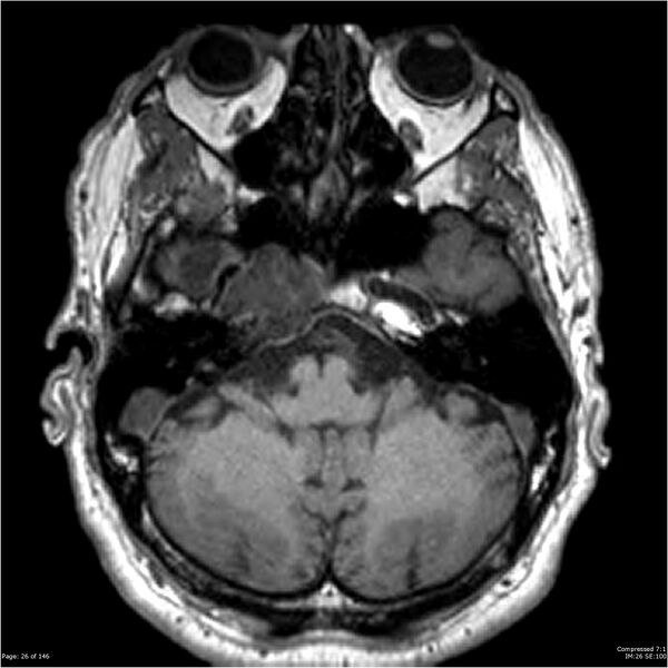 File:Chondrosarcoma of skull base- grade II (Radiopaedia 40948-43654 Axial T1 26).jpg