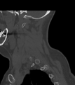 Chordoma (C4 vertebra) (Radiopaedia 47561-52188 Sagittal bone window 18).png