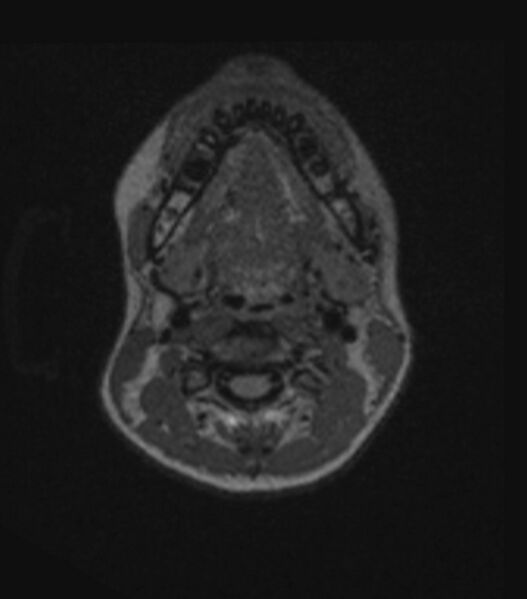 File:Choroid plexus carcinoma (Radiopaedia 91013-108553 Axial FLAIR C+ 28).jpg