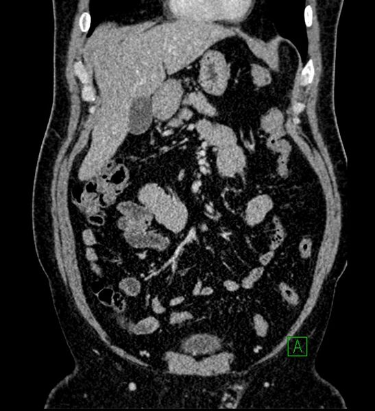 File:Chromophobe renal cell carcinoma (Radiopaedia 84286-99573 H 56).jpg