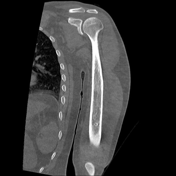 File:Chronic osteomyelitis (Radiopaedia 67597-76998 Coronal bone window 12).jpg