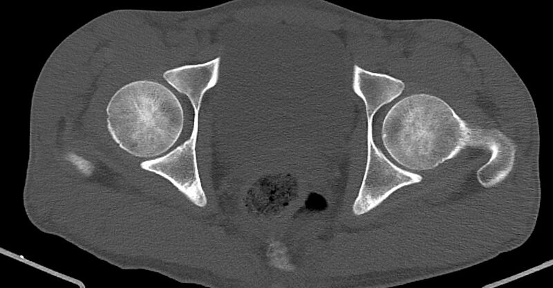File:Chronic osteomyelitis (with sequestrum) (Radiopaedia 74813-85822 Axial non-contrast 38).jpg