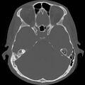 Chronic otomastoiditis (Radiopaedia 27138-27309 Axial bone window 48).jpg