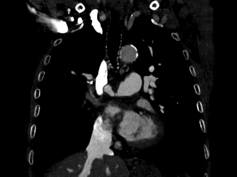 File:Chronic pulmonary embolism (Radiopaedia 91241-108843 A 48).jpg