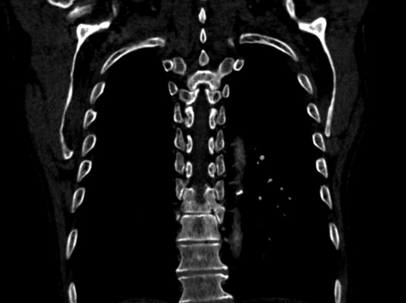 File:Chronic pulmonary embolism (Radiopaedia 91241-108843 A 92).jpg